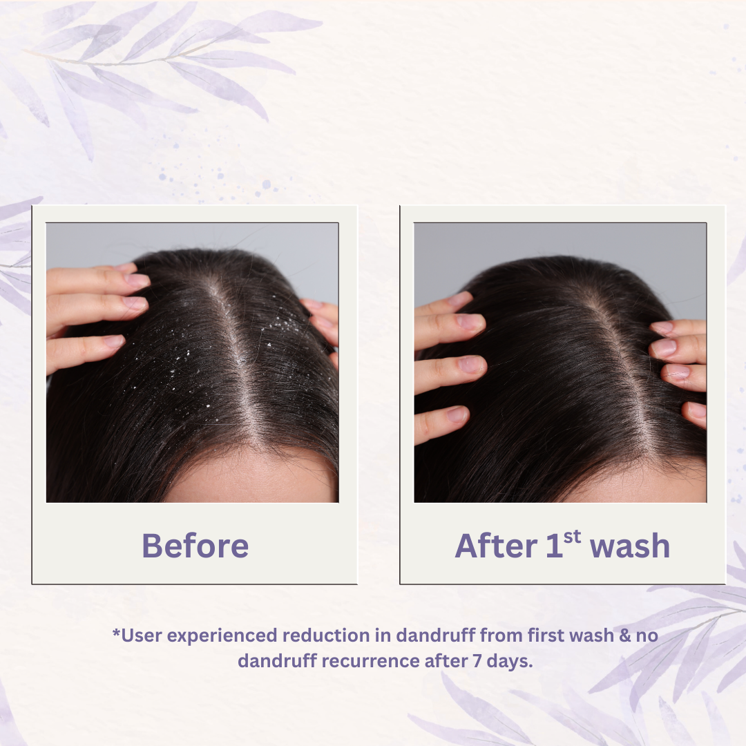 Dandruff Control